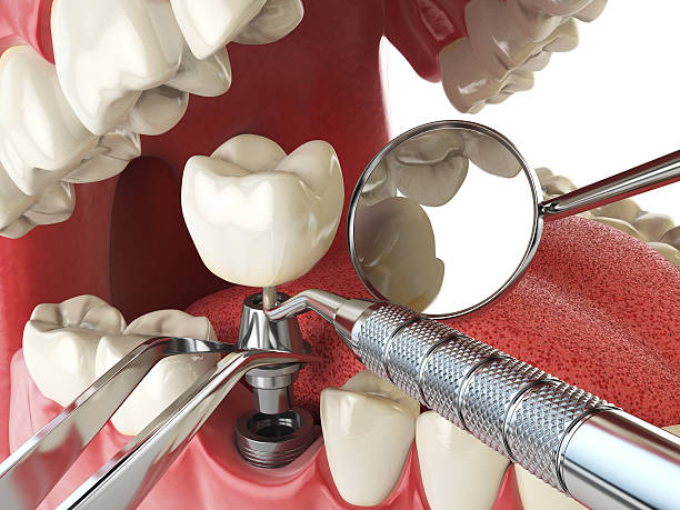 Best Emergency Root Canal Treatment in Anna, OH
